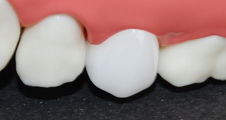 奥歯の被せ物（クラウン）ジルコニア