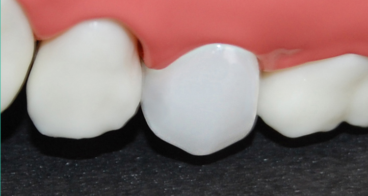 奥歯の被せ物（クラウン）ジルコニアセラミック