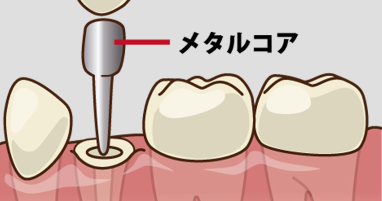 コア メタルコア