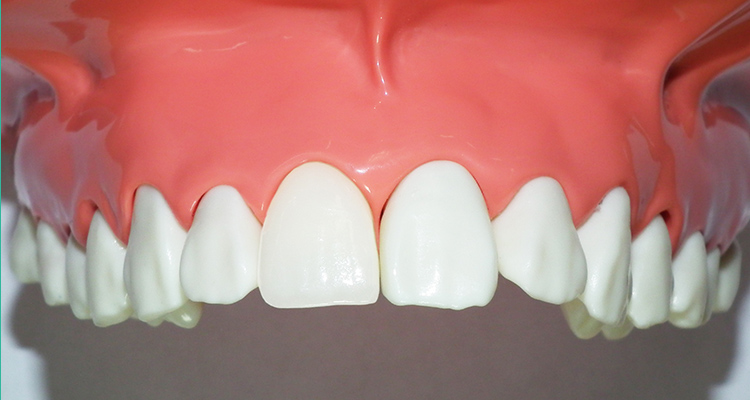 前歯の被せ物（クラウン） メタルボンド