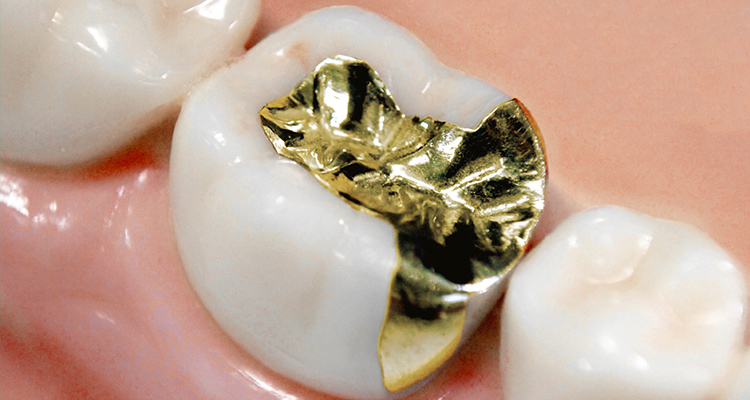 インレー ゴールド